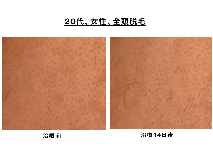 円形脱毛症　病院""